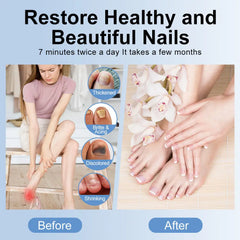 LED Nail Treatment, Nail Fungus Treatment Device DC-Funny Candle Co